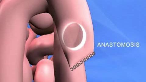 Figure 1. Photo captured from the animated video in the section that explains anastomosis. Copyright 2009 by Medical Animatics, LLC. Reprinted with permission.